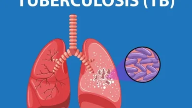 Photo of TB के 80 प्रतिशत मरीजों में नहीं दिखता यह एक लक्षण, जानें ताजा स्टडी का दावा