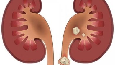 Photo of सेहत बनाने के चक्कर में किडनी कर रहे खराब! Vit-D के ओवरडोज से बढ़ रहा पथरी का खतरा